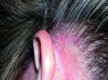 dermatite seborreica orelha